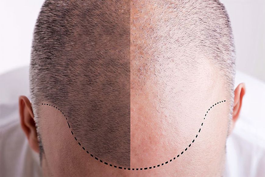 What is FUE Hair Transplant Surgery - Foreign policy